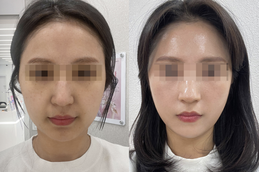 Before and after frontal view of Ultherapy and Thermage treatment