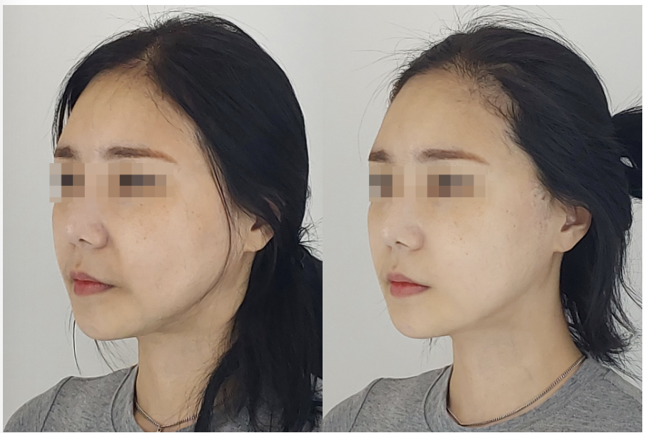 Before and after side view of Ultherapy and Thermage treatment