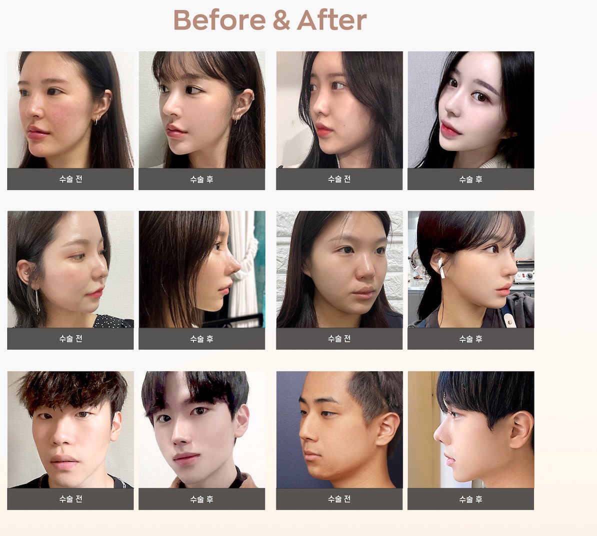 Rhinoplasty