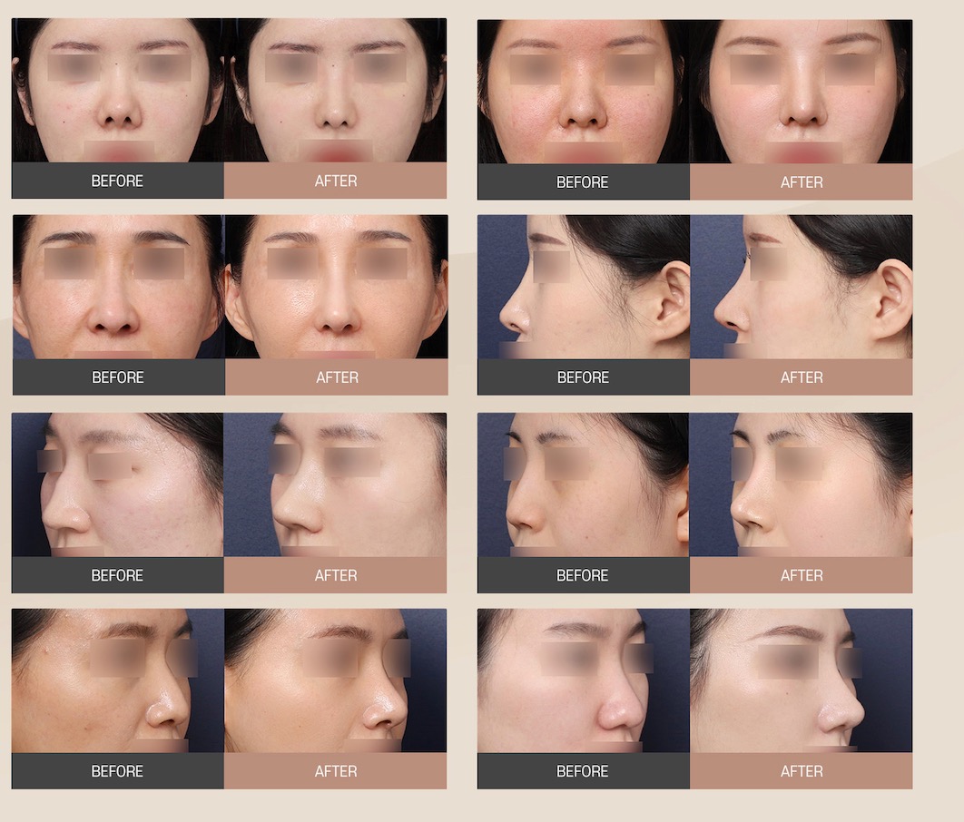 Nose surgery before after
