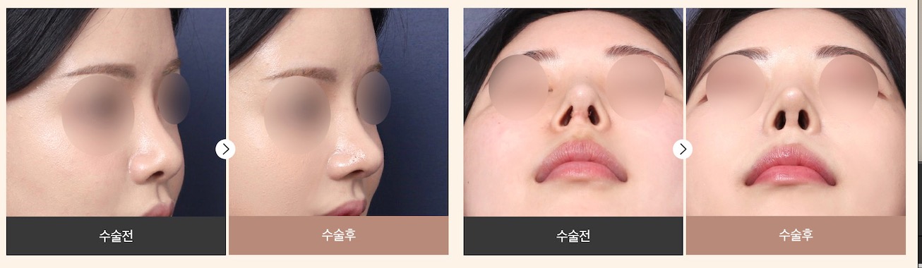 Nasal tip plasty before after