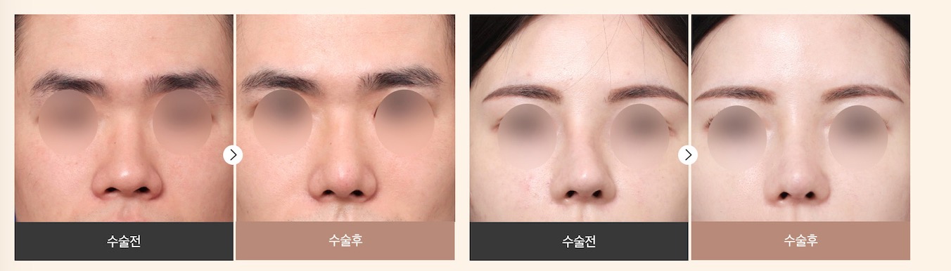 Alar reduction before after