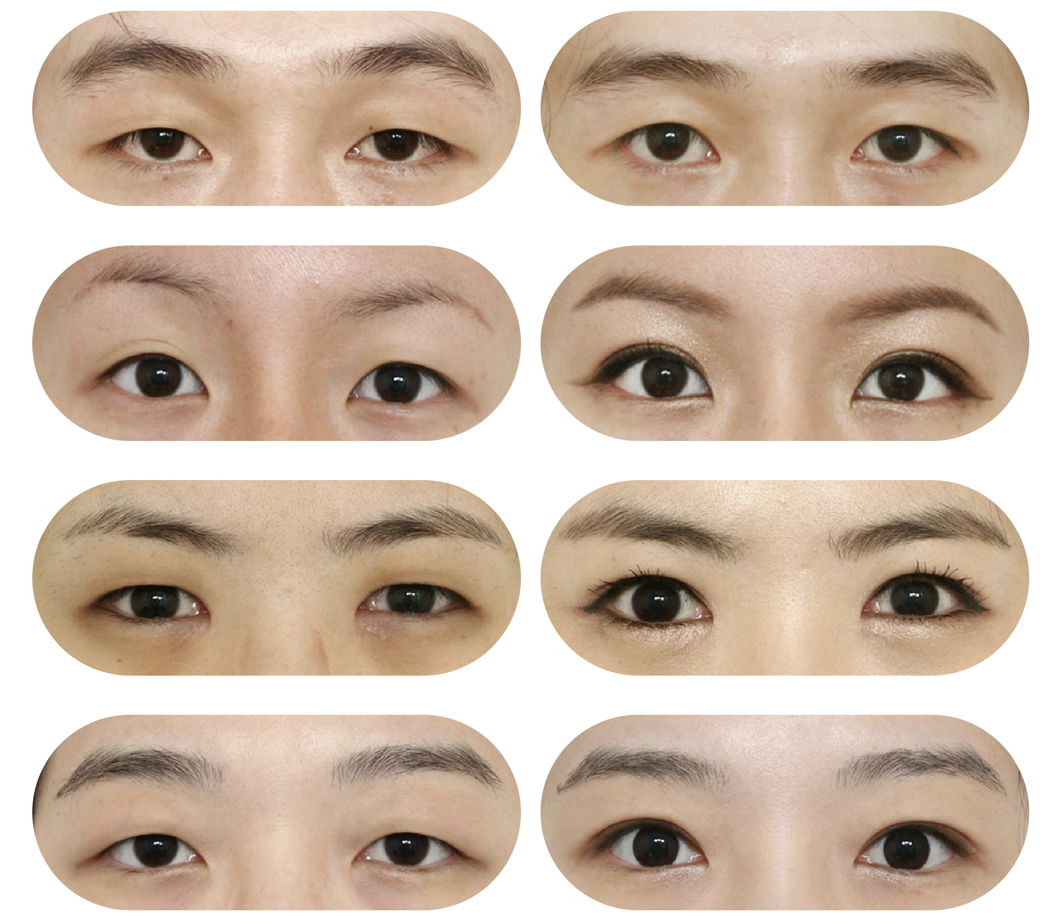 Double Eyelid