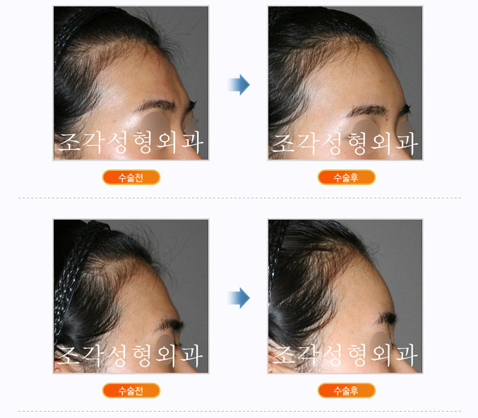 Forehead Augmentation Case
