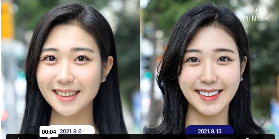 Dental Veneers Case