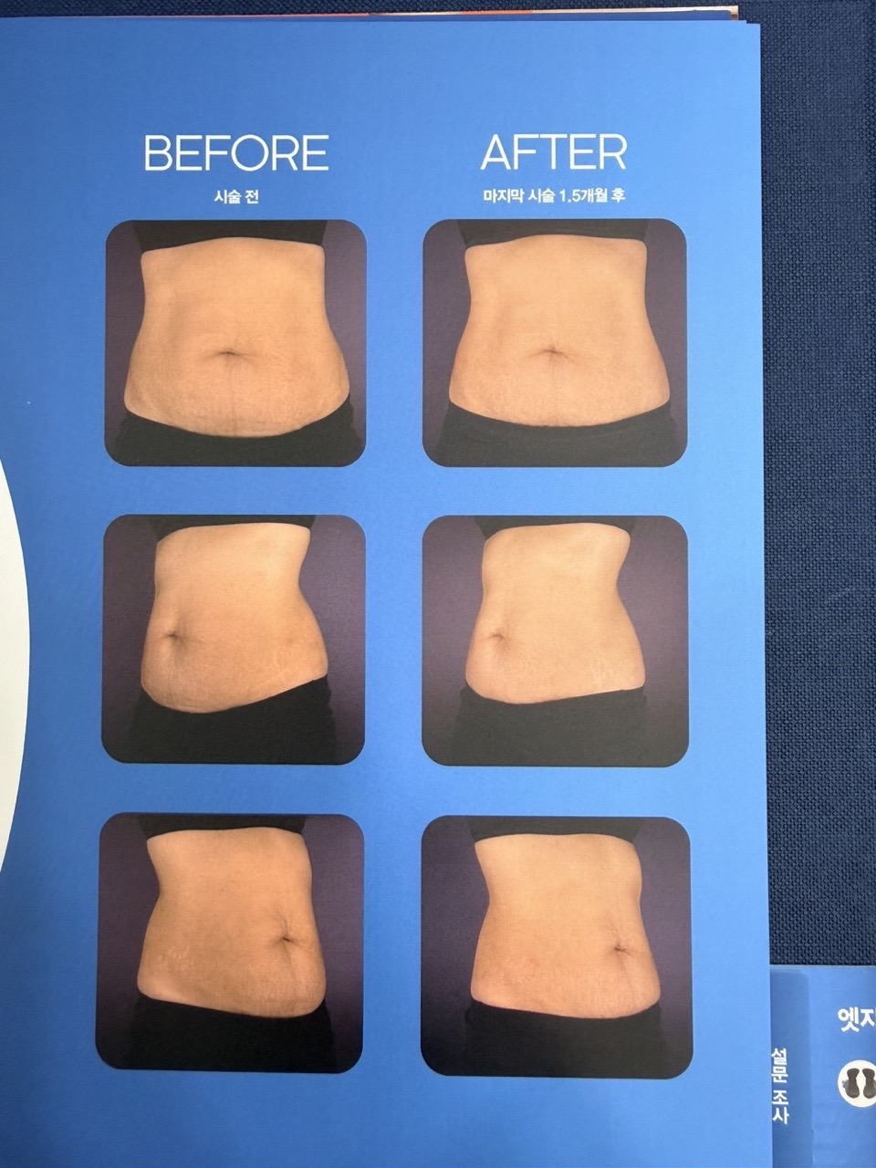 EMSculpt Neo腹部减脂增肌前后对比效果
