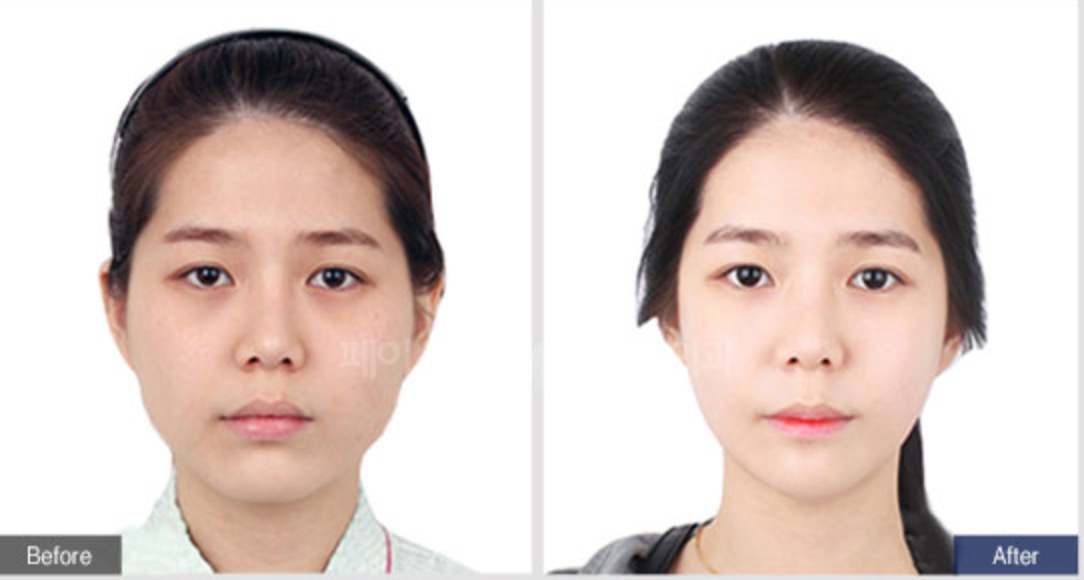 Cheekbone Reduction Before/After 1