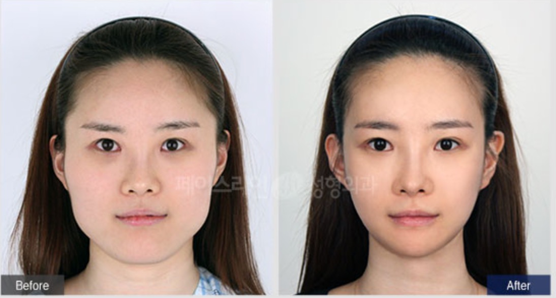 Cheekbone Reduction Before/After 2