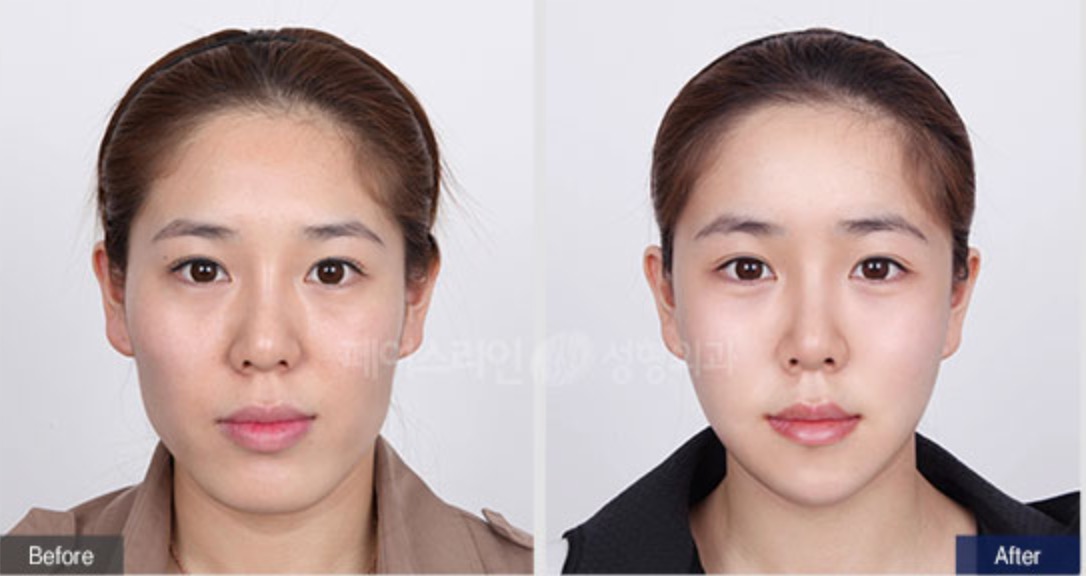 Cheekbone Reduction Before/After 3