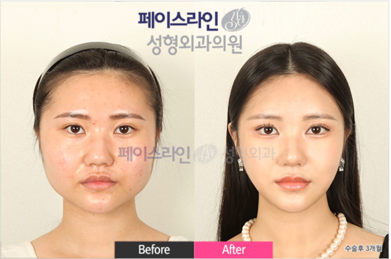Facial Contouring Before/After 1
