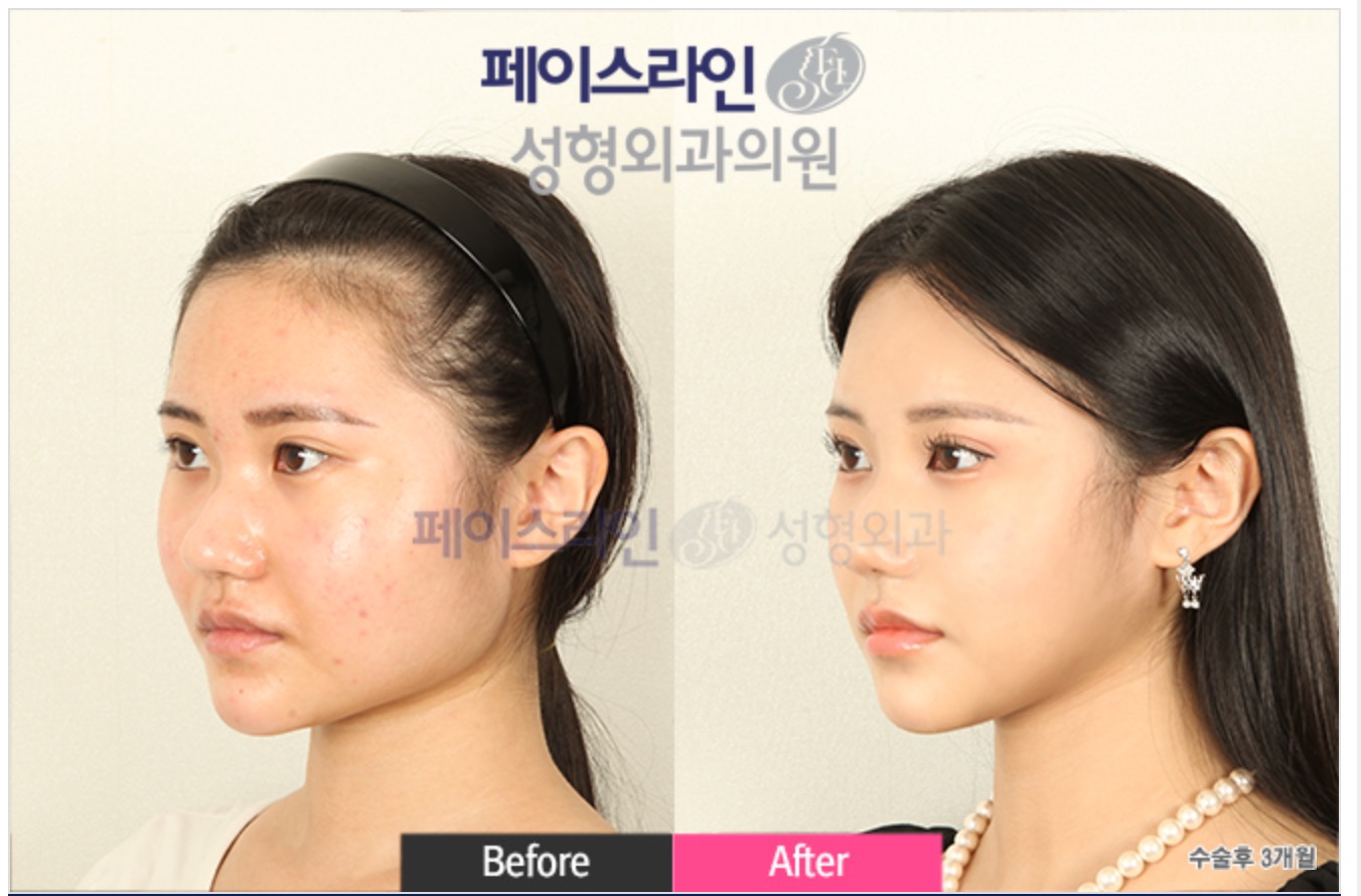 Facial Contouring Before/After 2