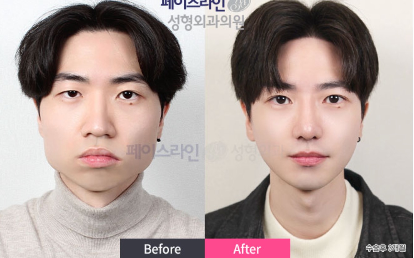 Facial Contouring Before/After 3