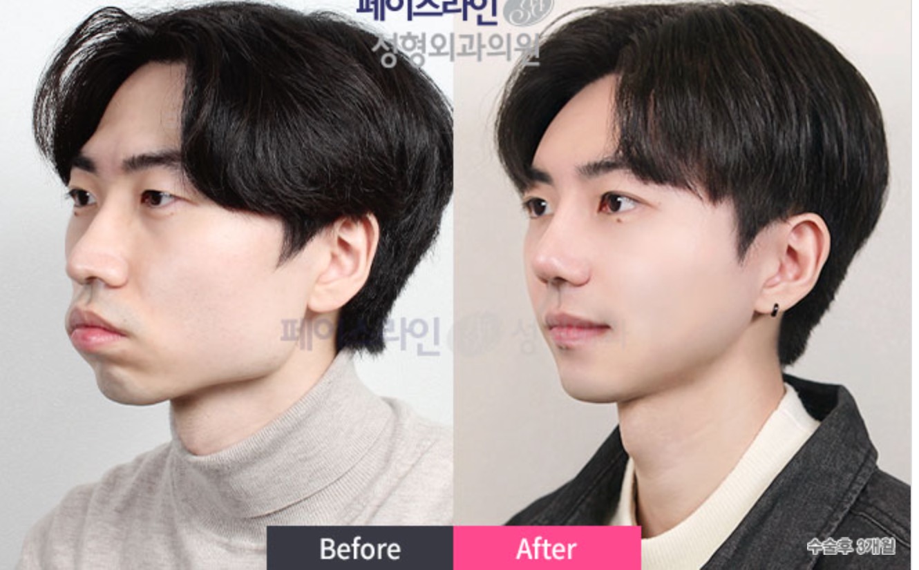 Facial Contouring Before/After 4
