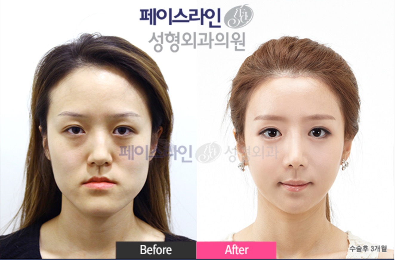 Double Jaw Surgery Before/After 1