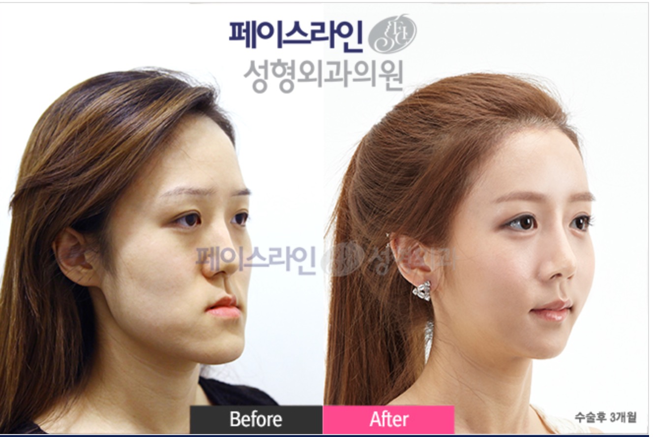 Double Jaw Surgery Before/After 2