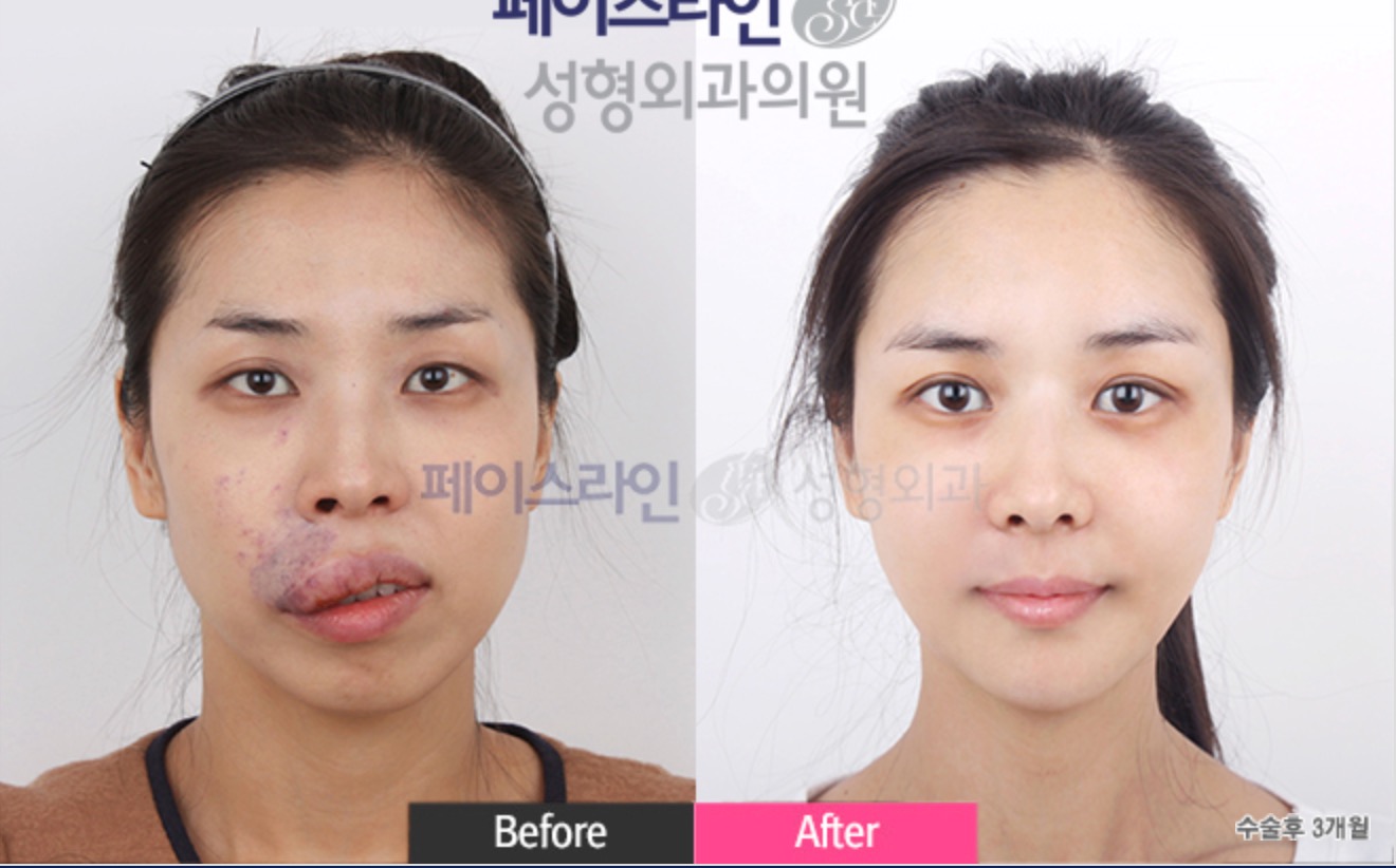 Double Jaw Surgery Before/After 3