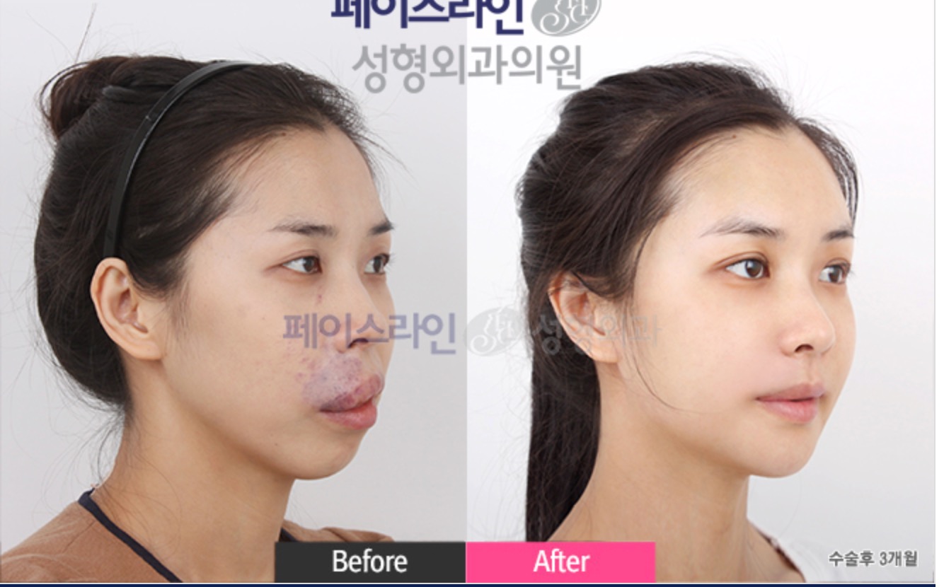Double Jaw Surgery Before/After 4