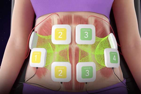 TruSculpt ID射频溶脂治疗区域示意