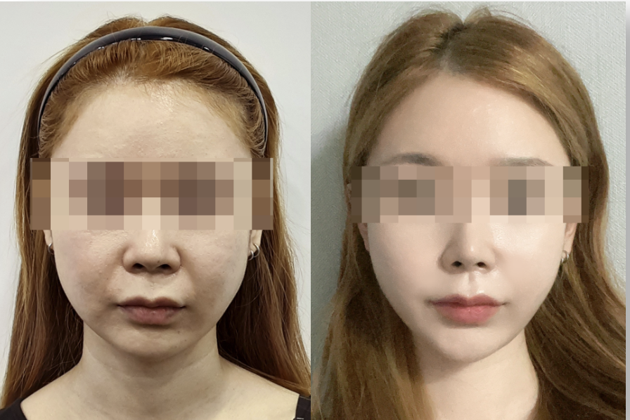 Minimally invasive cosmetic procedure