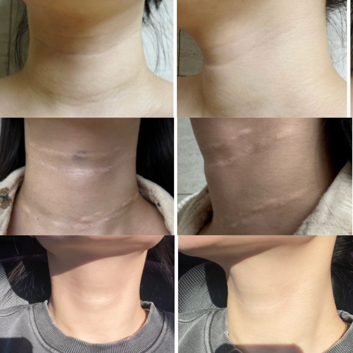 Contoh hasil perawatan kerutan leher dengan filler asam hialuronat