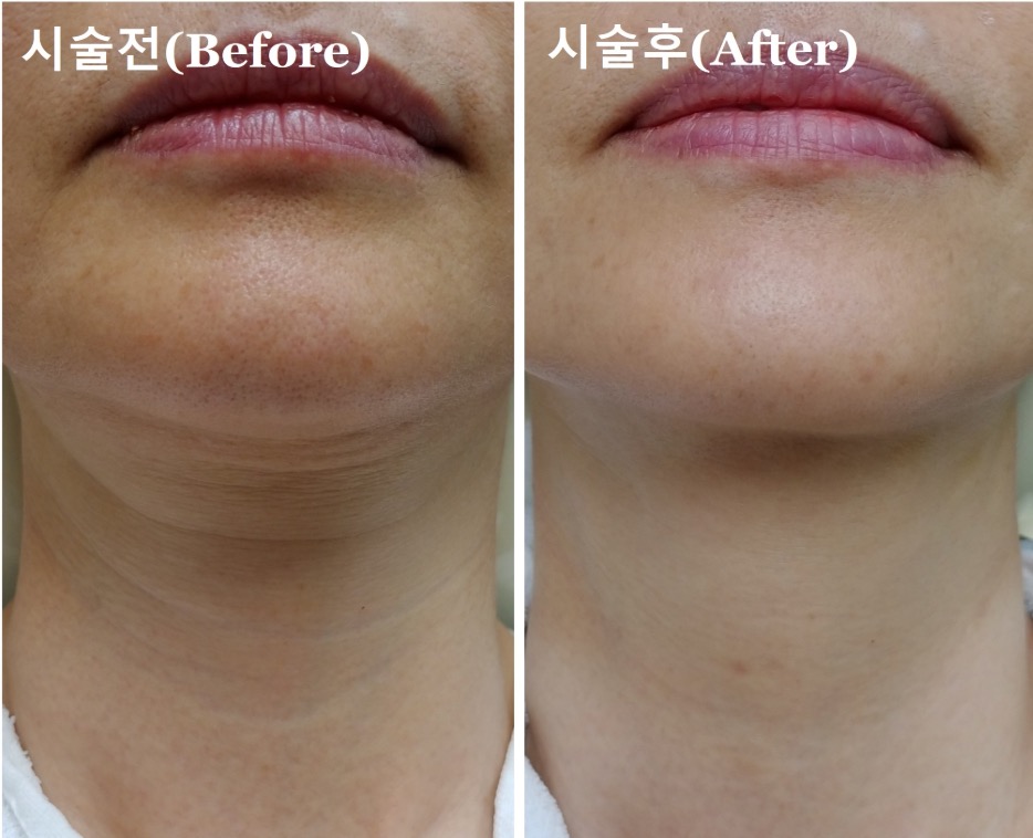 Thermage FLX vs HIFU สำหรับริ้วรอยคอในเกาหลี: เปรียบเทียบผลลัพธ์ ความเจ็บ และระยะเวลาครบทุกมิติ