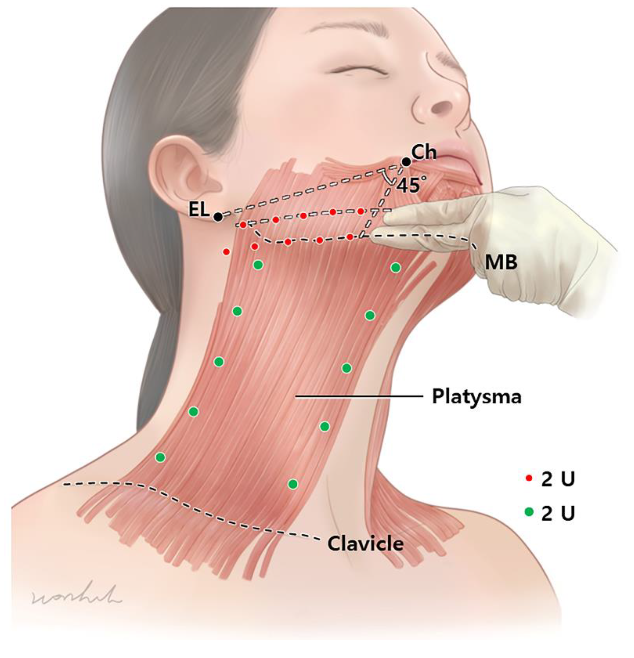 Titik-titik suntik botox pada leher