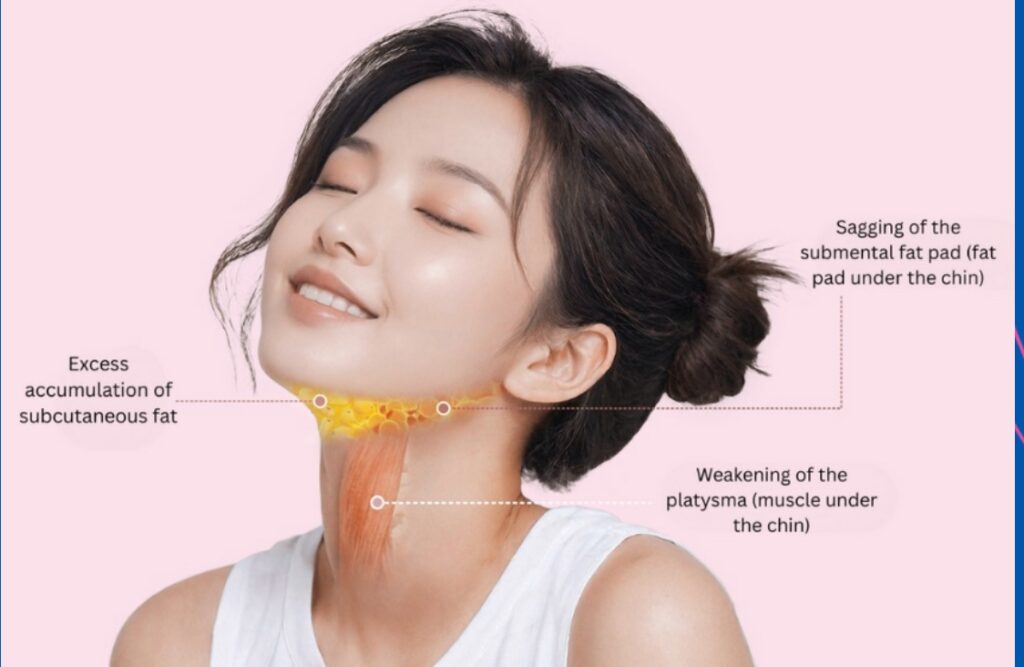 Perawatan Kerutan Leher di Korea: Operasi Platysma vs Botox – Apa Bedanya?