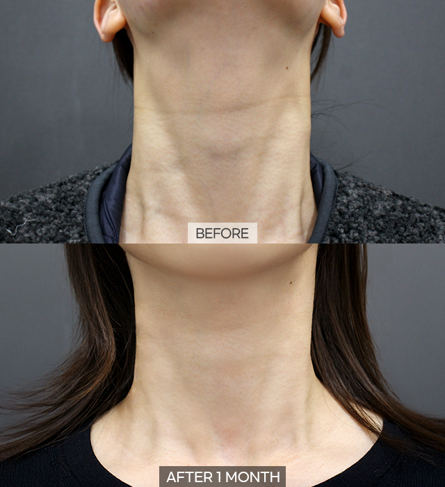 Neck treatment maintenance schedule overview