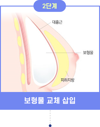 乳房重建第二阶段：假体更换示意图