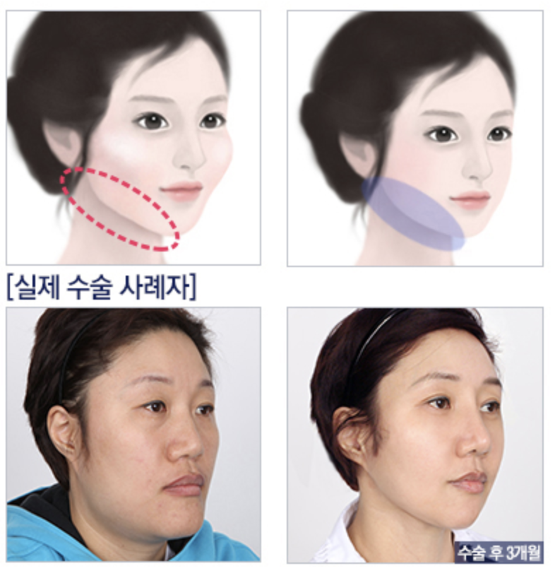 双鄂手术恢复