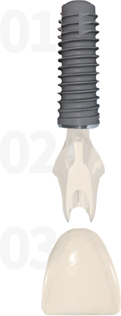 种植体三大组成部分