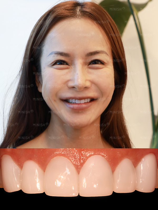 突出牙修复前后对比