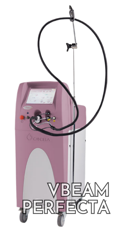 V-Beam Perfecta