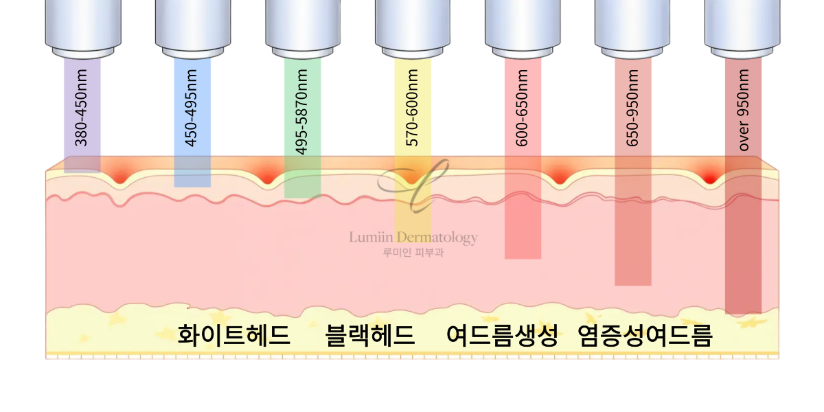 黄褐斑分型对比