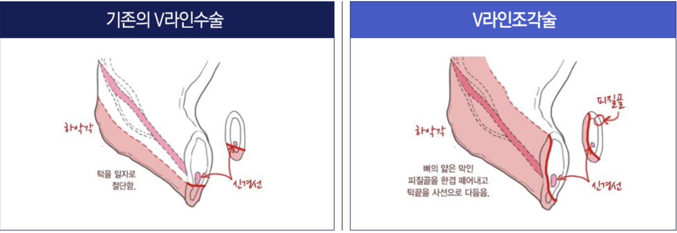 长曲线截骨对比