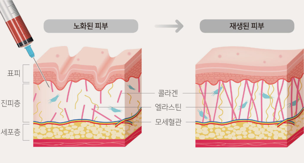 韓國真皮幹細胞再生療法完全指南：從真皮層啟動肌膚的年輕密碼
