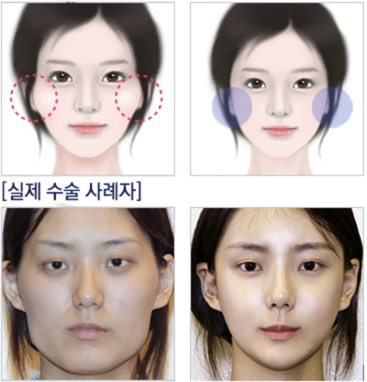 頬骨突出のタイプ