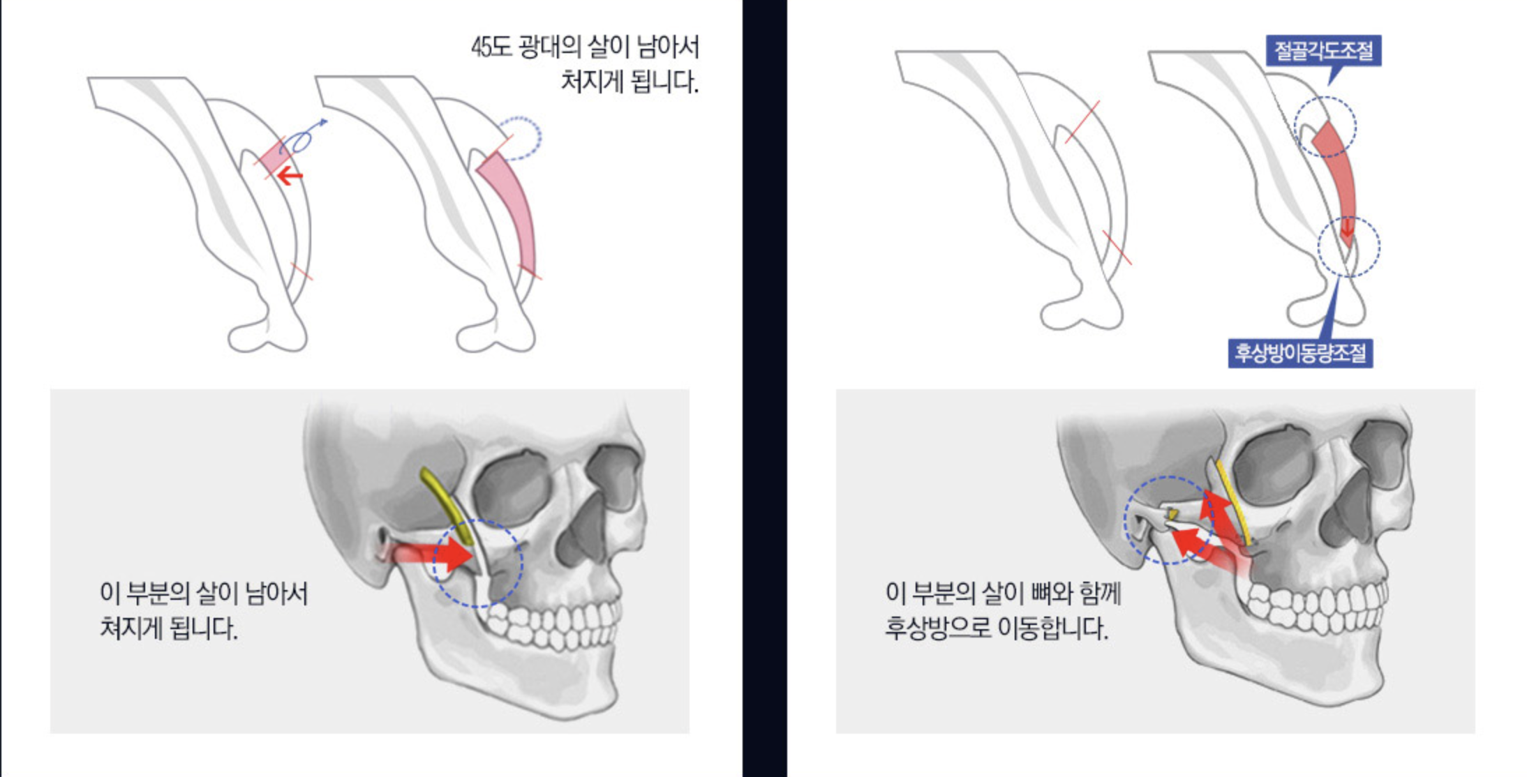 頬骨手術方法の比較