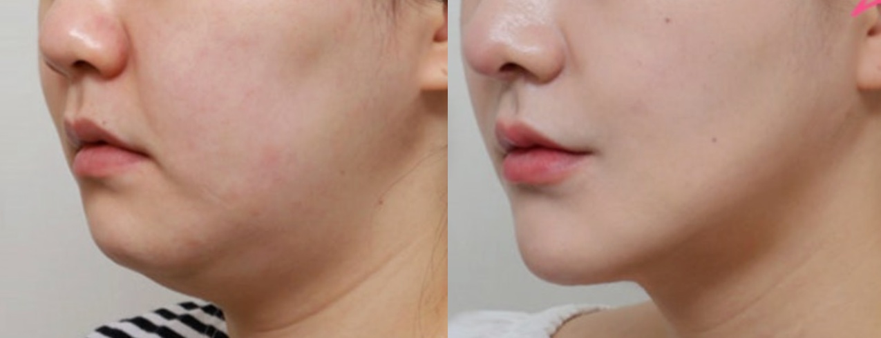 เปรียบเทียบก่อนหลังดูดไขมันใต้คาง+รัดกล้ามเนื้อ