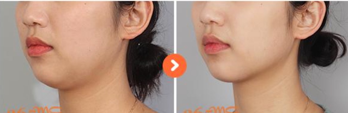 เปรียบเทียบก่อนหลังคางสองชั้นทำให้คอดูสั้น