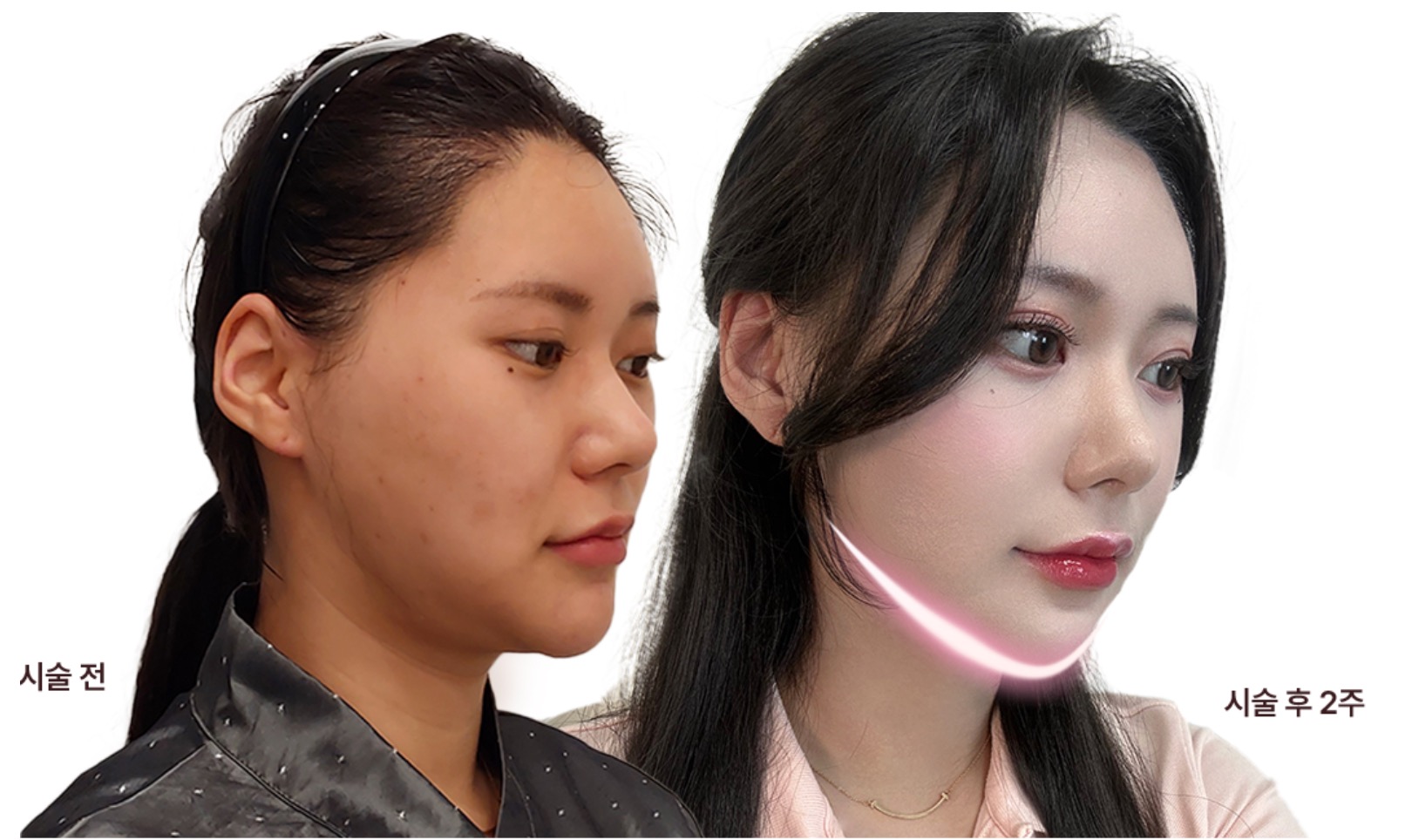 ผลลัพธ์การดูดไขมันใต้คาง+ผ่าตัดรัดกล้ามเนื้อ