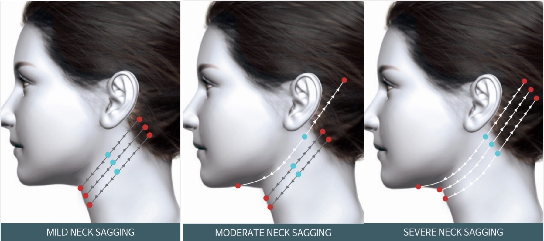 Neck laxity grading and treatment planning diagram