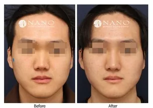 Korean Lydian Clinic female waist and abdominal side plastic surgery before and after cases