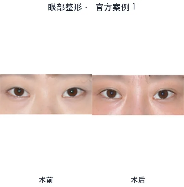 WILL Plastic Surgery Clinic Before-and-after cases 4