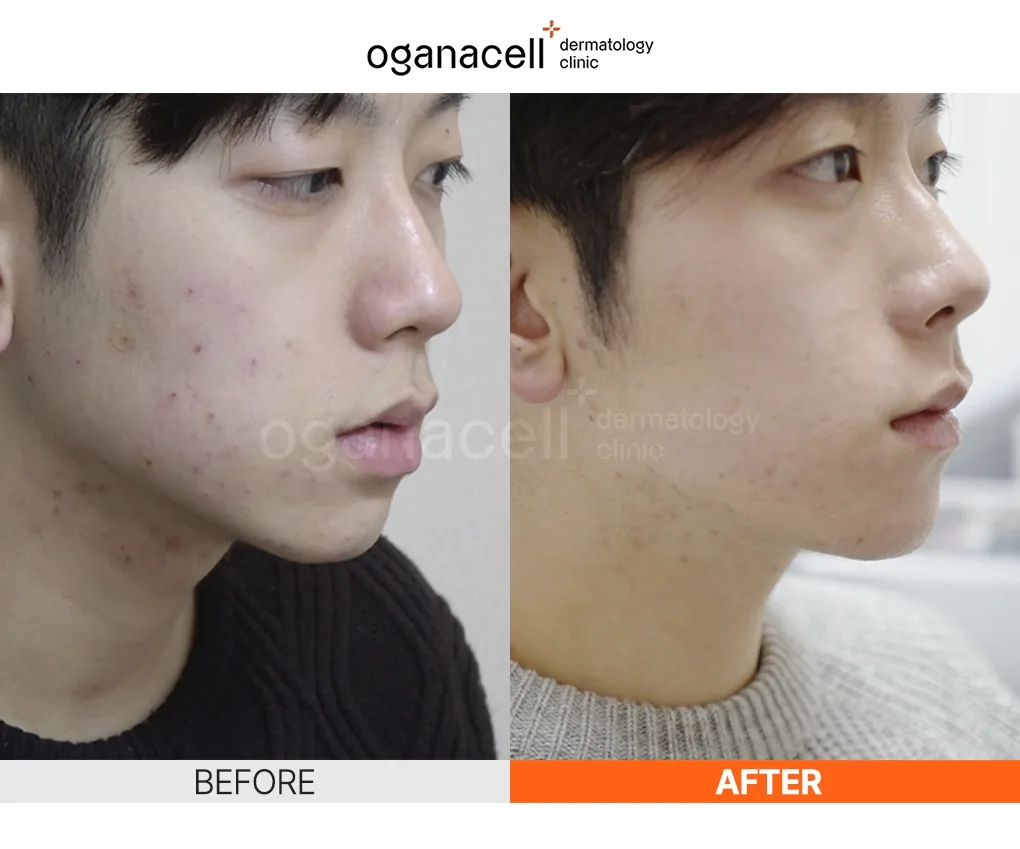 奥嘉娜Oganacell官方成人痘痘改善术前术后对比案例
