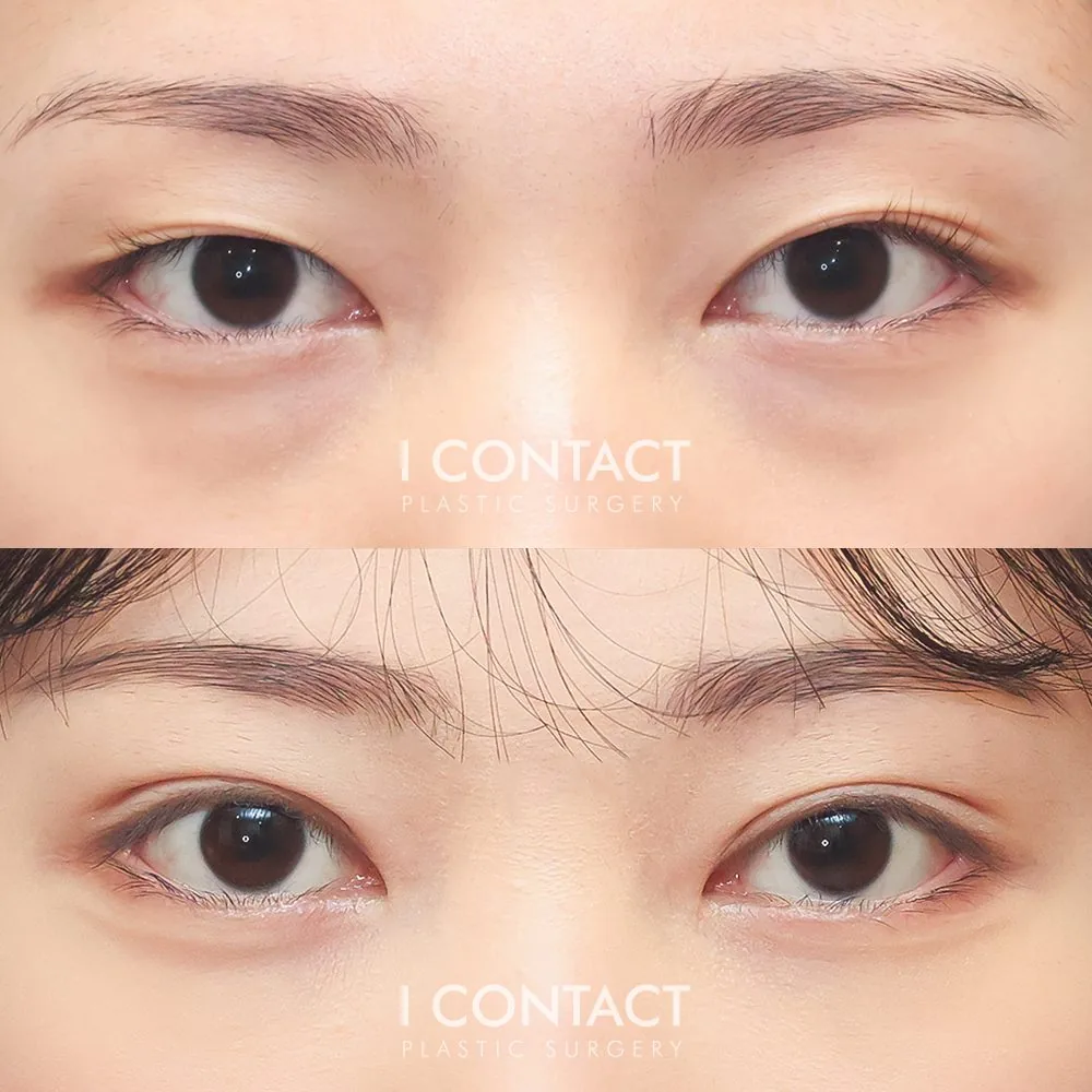 I contact整形外科 眼整形术前术后对比