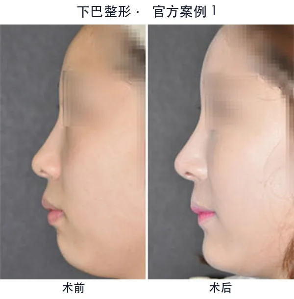 WILL Plastic Surgery Clinic Before-and-after cases 10