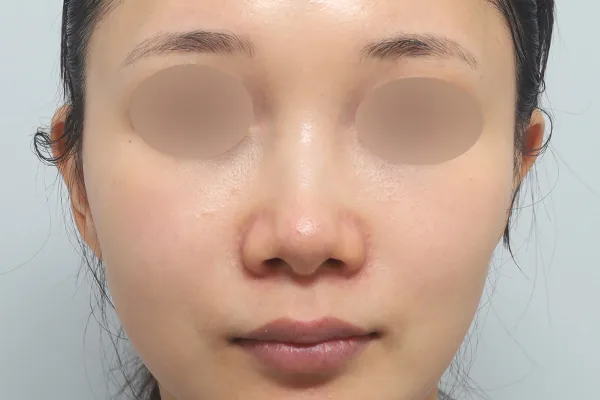 鼻部整形案例1术前