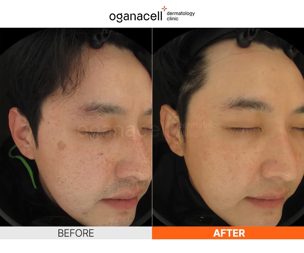奥嘉娜Oganacell官方色斑与肤色改善术前术后对比案例 2