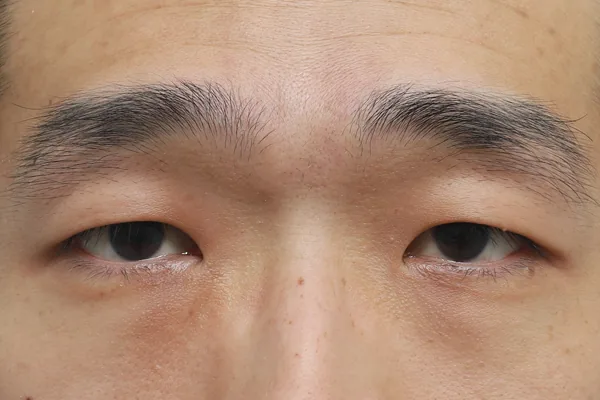 眼部整形案例2术前